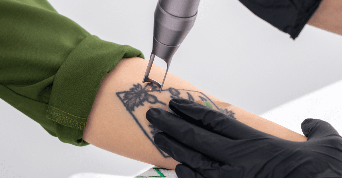 Laser Tattoo Removal Aftercare Guide | Celebrity Ink